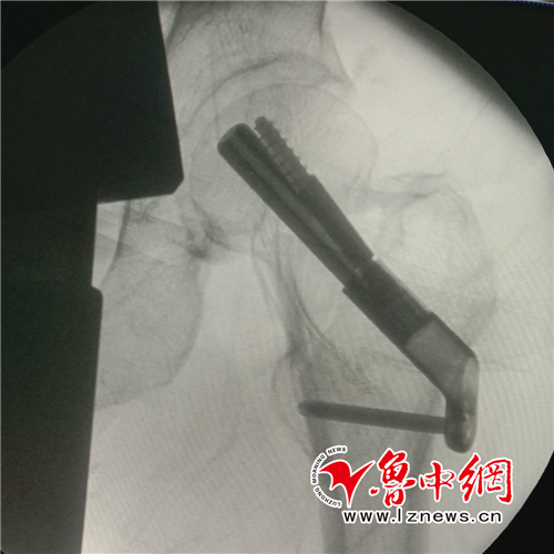 老年股骨颈骨折人工髋关节置换不再是首选——记鲁中首次fns保髋治疗