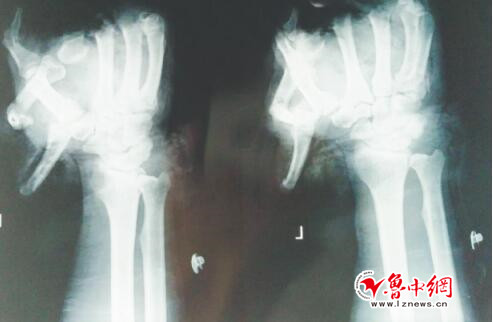 淄博男子酒后放鞭炮炸伤左手 春节假期被烟花爆竹炸伤的患者比往年少了很多