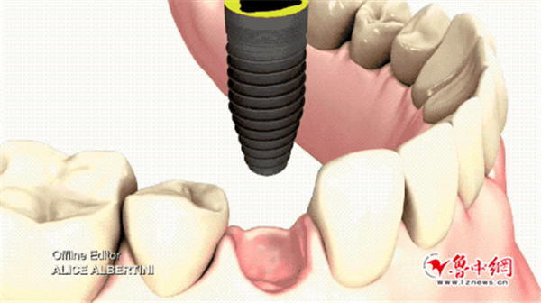 与以前的假牙相比,种植牙符合人体机能原理,依靠独立牙根扎根于牙槽骨