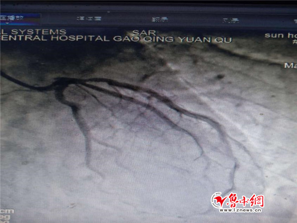 高青县人民医院心内科成功应用药物球囊扩张术治疗冠心病